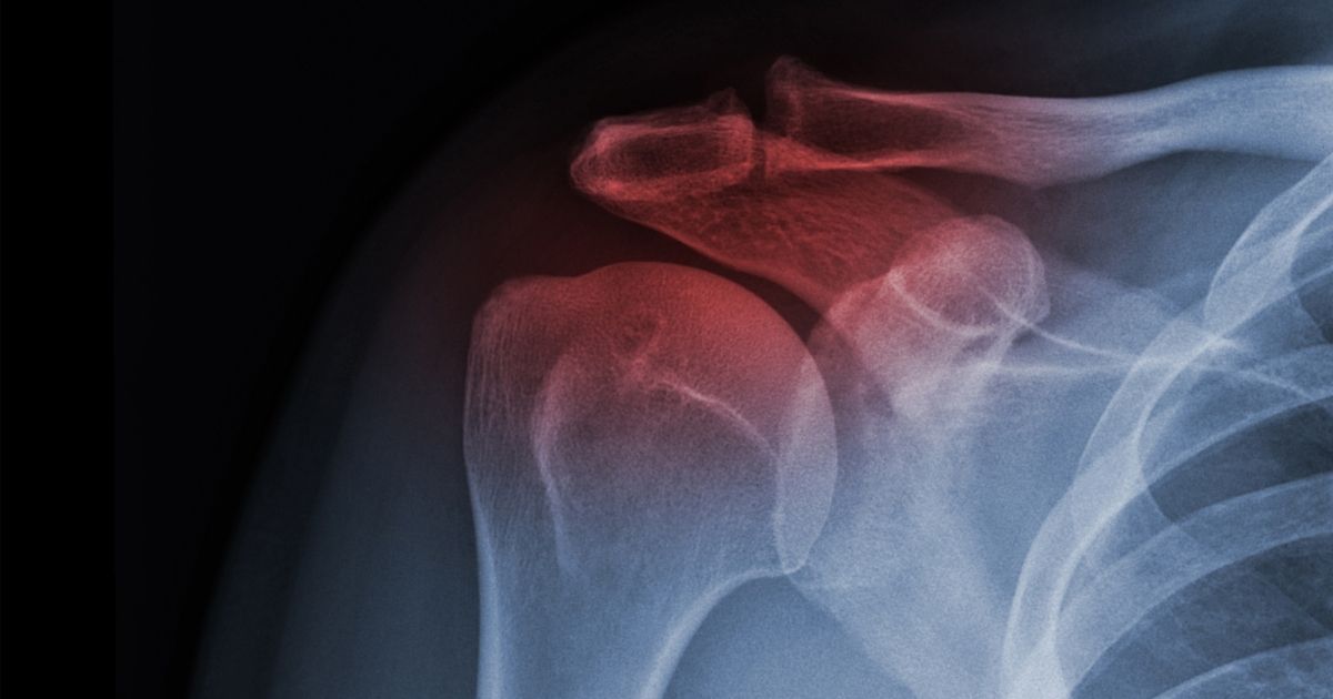 What to Do When You Have Shoulder Pain After a Car Accident