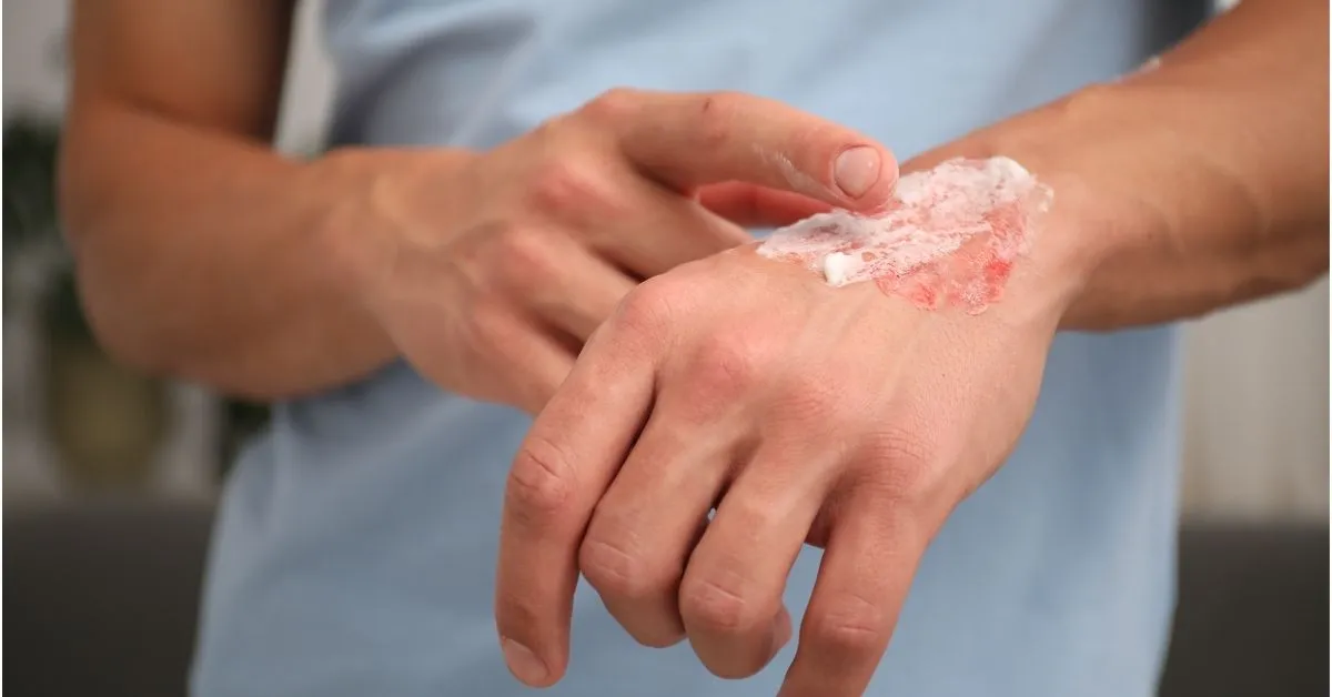 What Types of Burn Injuries Are Caused by Truck Accidents?